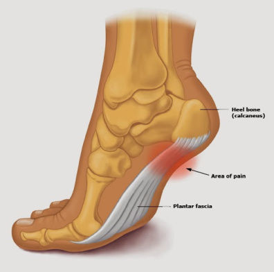 foot pain plantar fascia